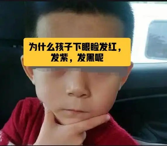 为啥孩子有眼袋下眼睑发红发黑发紫