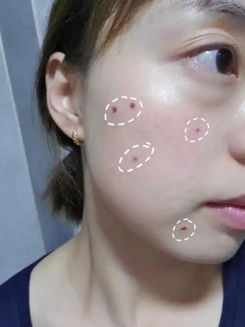 闺蜜俩真实点痣经验分享