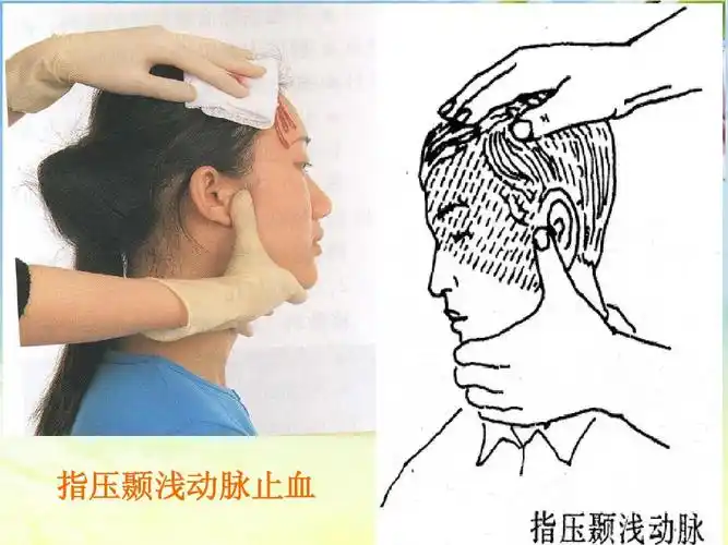 指压颞浅动脉止血