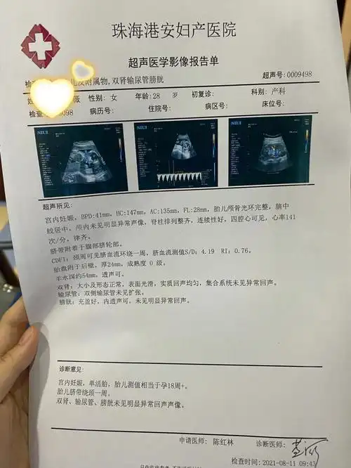 1821周脐带绕颈一周