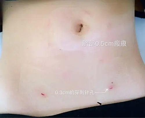 腹腔镜下小儿腹股沟斜疝疝囊高位结扎术