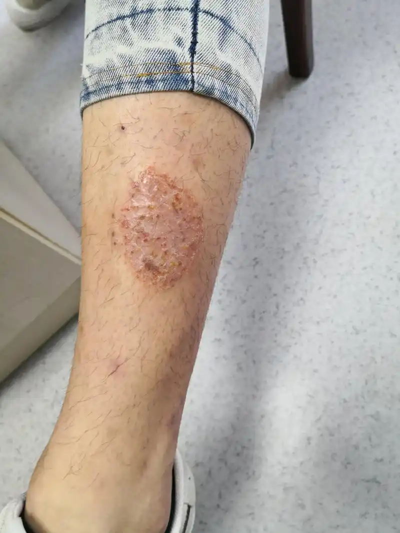 小腿湿疹症状.斑块状湿疹.真菌阴性#湿疹