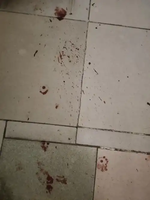 讨论/科普|【讨论】后续 外伤有图慎入    一觉醒醒来 楼梯地板有血