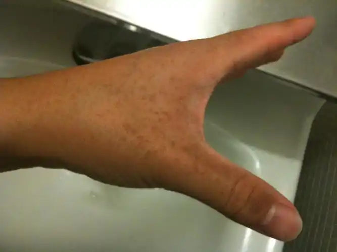 手上长斑点是怎么回事 怎么治疗