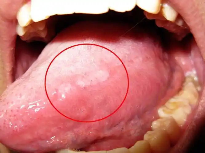请问是舌头白斑吗