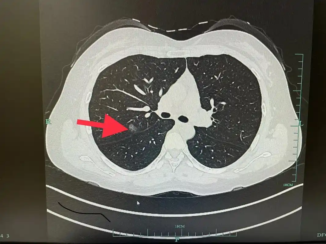 查出肺结节也不可怕,90%以上都是良性 - 抖音