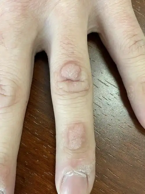 手上长了瘊子怎么治疗