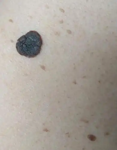 脂溢性角化怎么治疗