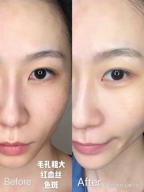 放一张前后对比图~三年光子嫩肤经历,第一年5次,后两年每年一次维护