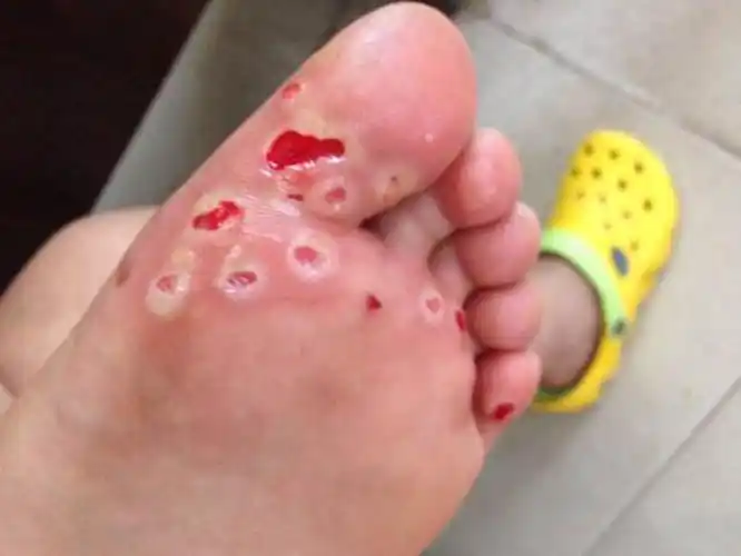 跖疣图片跖疣初期图片