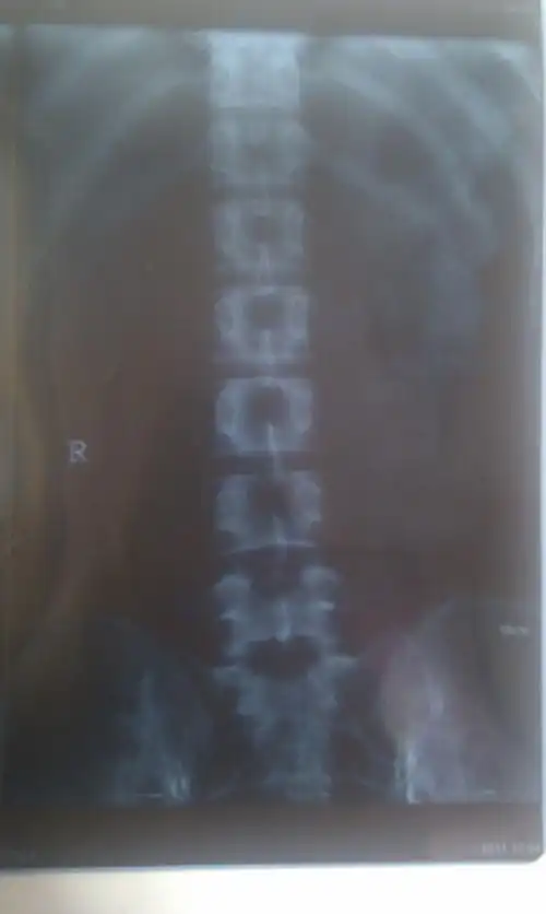 我这个属于骶骨隐裂么?