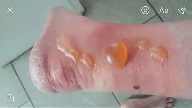 动物篇235虻叮咬重口慎入