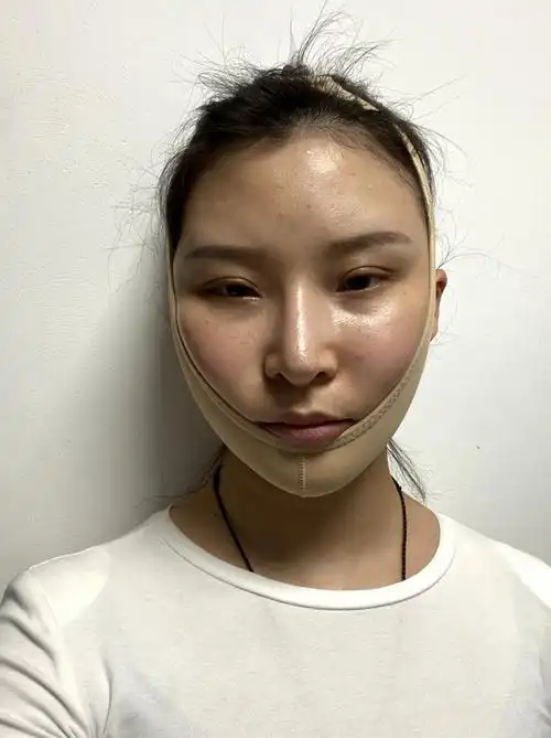 【面部吸脂术后第5天】今天去医院复查了一下,心情还算不错,因为摘下