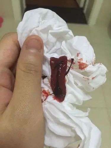 次次来大姨妈都会有这么大的血块是因为什么?