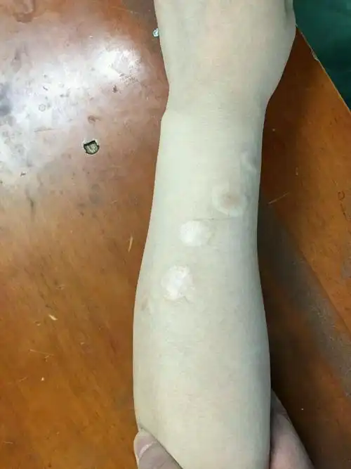 用烟头烫伤自己的女孩