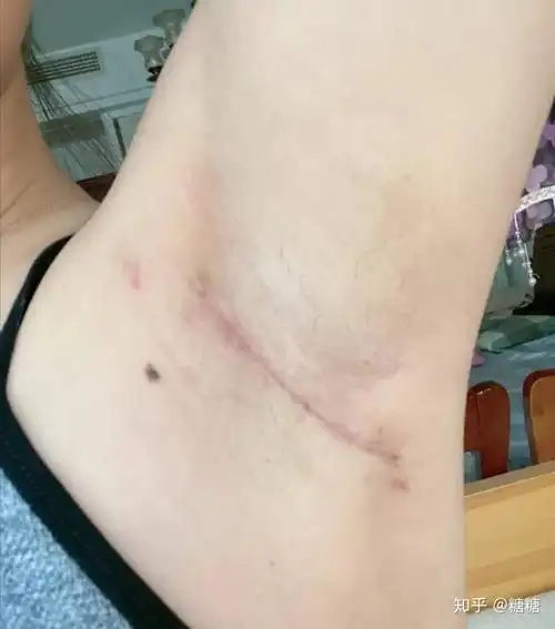 副乳切除术 - 知乎