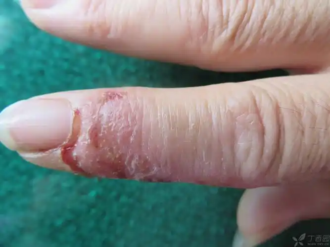 【请教】右手食指皮疹3个月了,考虑肢端皮炎?湿疹?还是真菌感染?