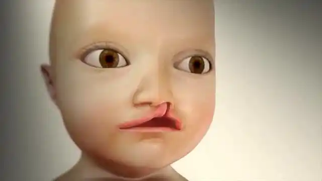 小孩天生兔唇怎么办?动画演示:唇裂修复手术全过程,看着真疼!