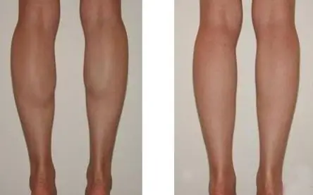 当代瘦腿针前后对比图