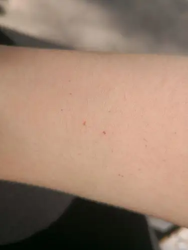 两只手臂上有不少小红点,是