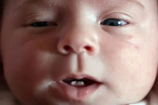 婴儿马牙图片 (50)_有来医生