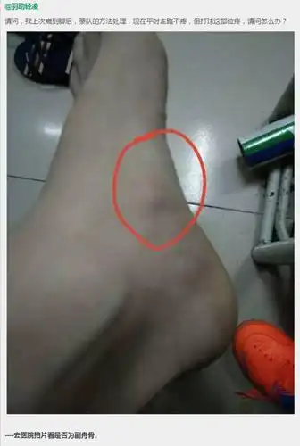 踝关节常见伤病足副舟骨疼痛