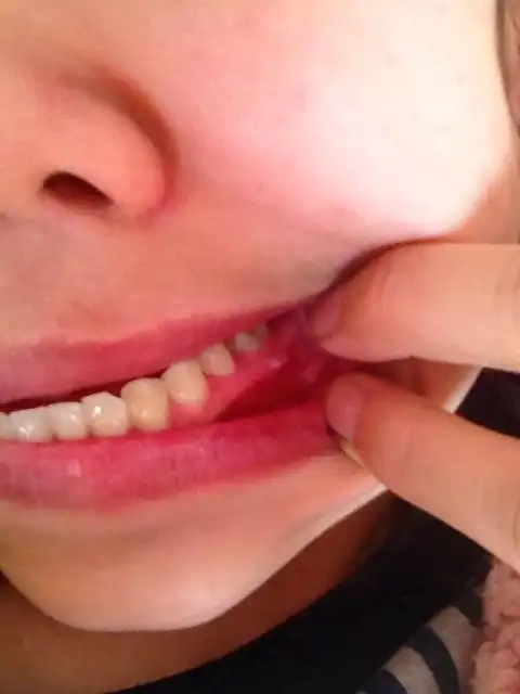 在牙龈上长了个硬疙瘩 有个白色的尖尖 不痛不痒 以前这个牙有补过 这