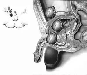 23年前得病切睾丸去年检查发现还在
