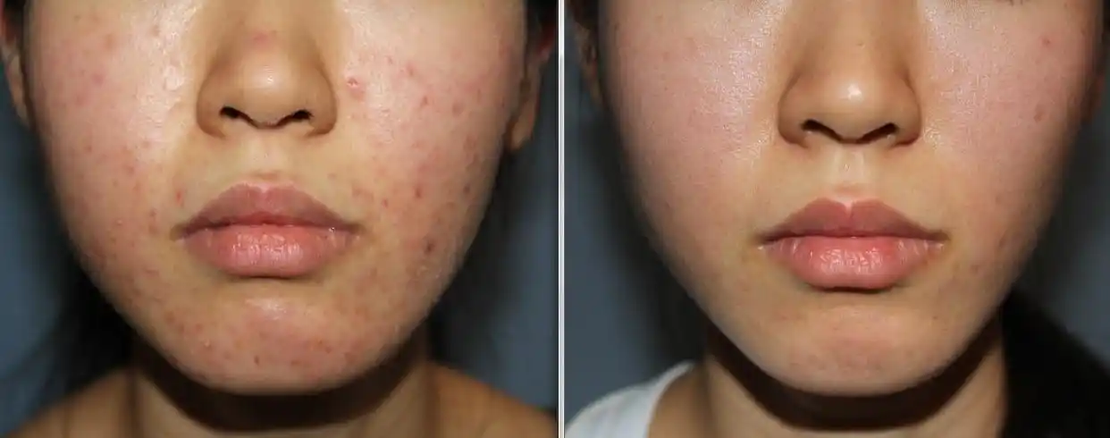 素颜杀手-暗疮肌