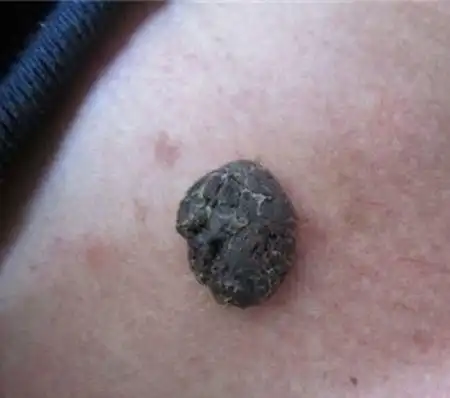 色素痣的图片_色素痣