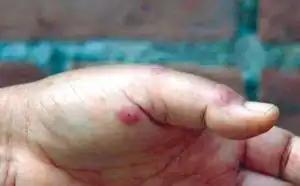 被红火蚁叮蛰后,一般被叮蛰部位会有刺痛感,火烧感,同时出现水泡和