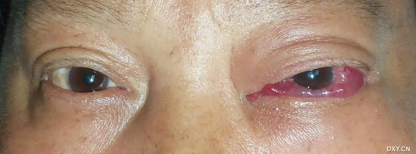 【讨论】上颌动脉分支海绵窦瘘一例