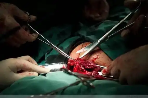 由内及外一层层缝合,总共也要缝七层这些手术用线是可以被人身吸收的