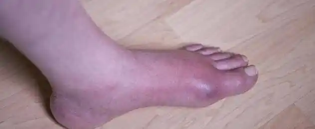 脚上出现3大症状,痛风无疑,需要溶解尿酸控制痛风恶化