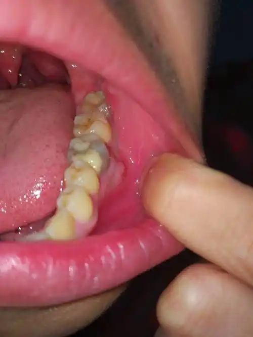 牙齿根的肉那里长了一个大包,一开始不痒不痛,现在感觉牙齿有点酸胀感