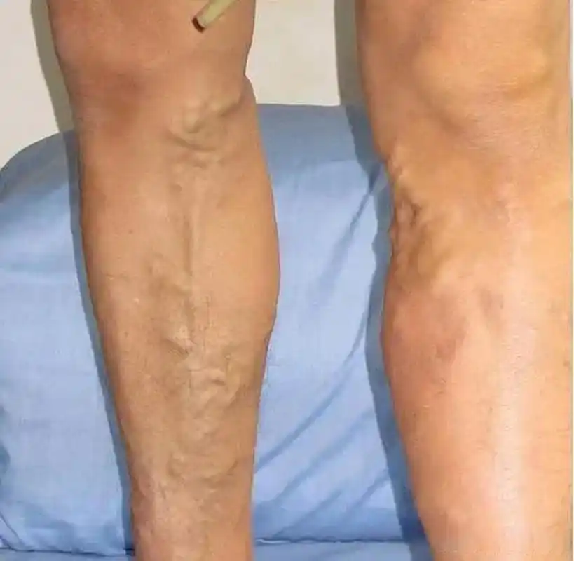 小腿青筋隆起,就是我们临床上说小腿静脉曲张.