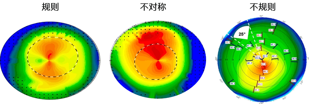 地形图引导的个性化适应症的扩充77角膜疤痕77不规则切削77小光