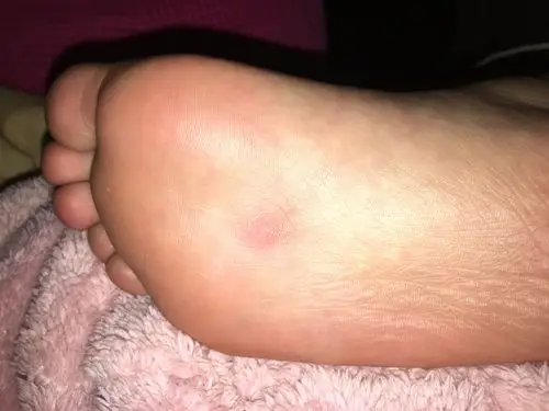 脚心有硬块,表面什么也没有,能摸出在皮下.已经很多年了.