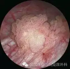 膀胱肿瘤术后即刻膀胱内化学药物灌注可破坏残留的肿瘤细胞,防止肿瘤