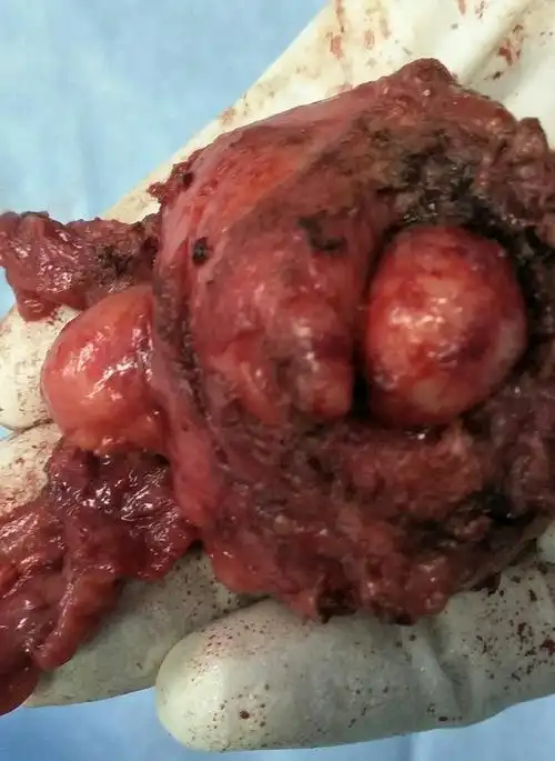 幸福是奋斗出来的,本周四天手术,五台腹腔镜前列腺癌根治顺利完成