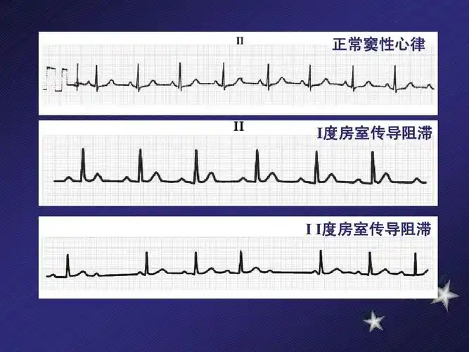 正常窦性心律 i度房室传导阻滞 房性早搏 i i房室交界性早搏 度房室