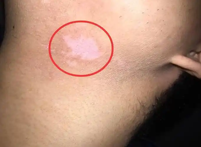 身上有白斑图片(皮肤上长白斑) - 赤虎壹号