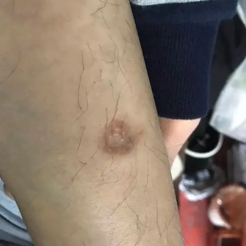 受了皮肉伤后留疤怎么恢复