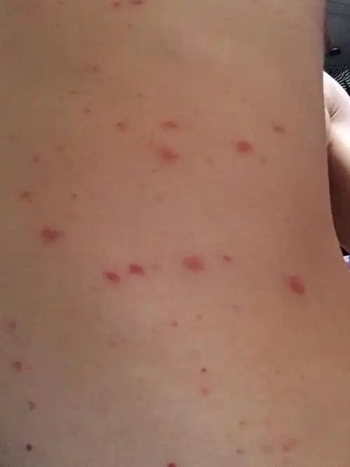 为什么天气一热就后背痒(天气一热后背就痒是怎么回事)