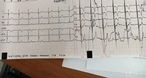 停药后心率较少增快,但仍然比较齐,房颤病史,此图是否为地高辛中毒