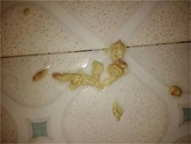 宫颈糜烂三度排出物的图片