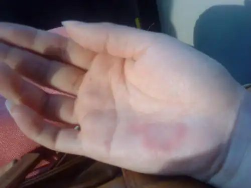 谁能帮我解释一下这手掌上红圈到底是什嚒情况?