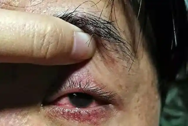 西安小伙喝饮料遭飞来横祸眼睛差点失明原因竟是因为使用不当