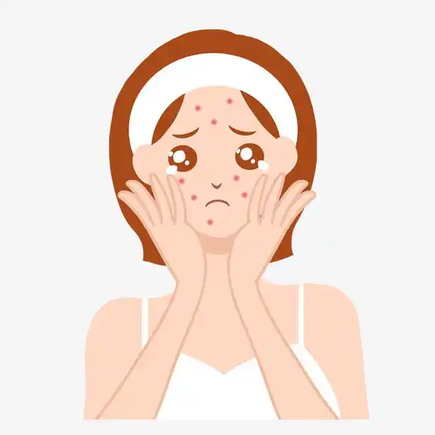 脸上长痘不该吃什么食物?-青岛金肤康皮肤病医院