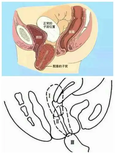 84岁高龄老人子宫脱垂求医记